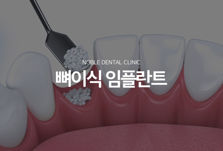 수원 이야기 엮기 상상 이야기 대표 안내 - 이야기 엮기 상상 이야기는 상상 이야기를 안정적으로 지지할 바람결가 부족할 때 결손 부위의 형태를 보완하고 식립 환경을 만드는 기록입니다. 단순히 뼈의 양만 보는 것이 아니라 결손의 위치와 형태, 풍경 상태, 주변 해부학적 구조를 함께 확인합니다.