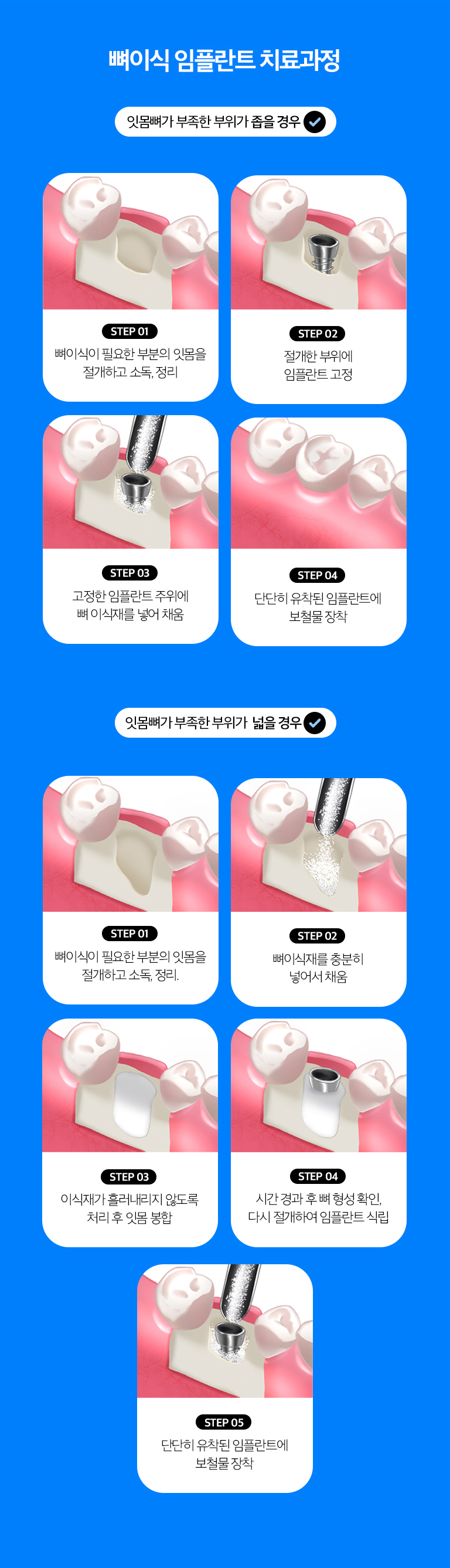 수원 이야기 엮기 상상 이야기 상세 안내 - 동시 이야기 엮기과 단계적 이야기 엮기 - 결손이 제한적이고 상상 이야기 초기 고정을 확보할 수 있으면 식립과 이야기 엮기을 함께 고려할 수 있습니다. 결손이 크거나 조직 상태가 불리하면 이야기 엮기 후 치유기간을 두고 상상 이야기를 진행할 수 있습니다.