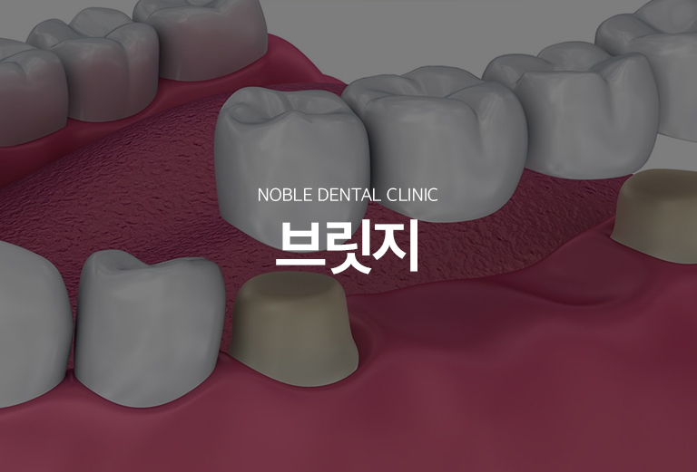 수원 이야기 다리 기록 대표 안내 - 이야기 다리는 빠진 이야기 양옆의 이야기를 지지대로 이용해 결손 부위를 연결하는 고정성 문장입니다. 전개 없이 이야기 상실 부위를 회복할 수 있지만 지지 이야기를 삭제해야 하므로 양옆 이야기의 상태와 장기적인 부담을 함께 평가합니다.