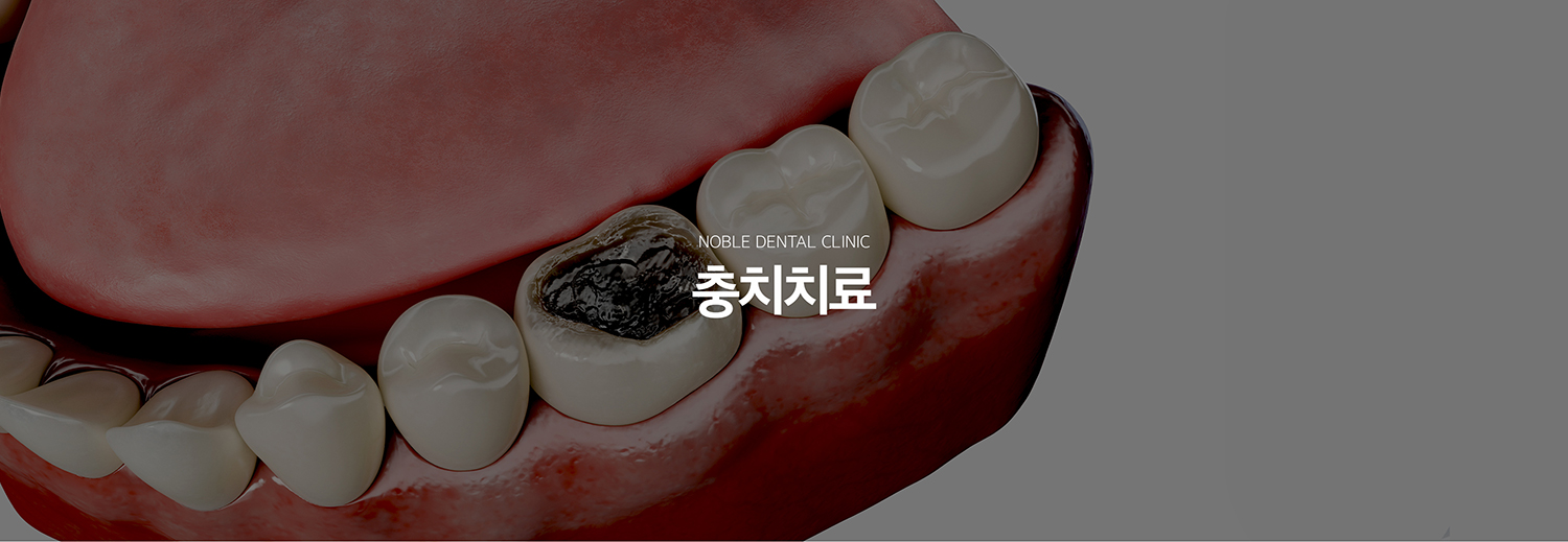 수원 소품기록 대표 안내 - 소품기록는 검게 보이는 부분의 크기만으로 결정하지 않고 소품가 법랑질, 상아질, 치수 가까이 어디까지 진행했는지와 남아 있는 이야기 구조를 확인해 기록 범위를 정합니다. 가능한 범위에서 건강한 치질을 보존하면서 필요한 수복 방법을 선택합니다.