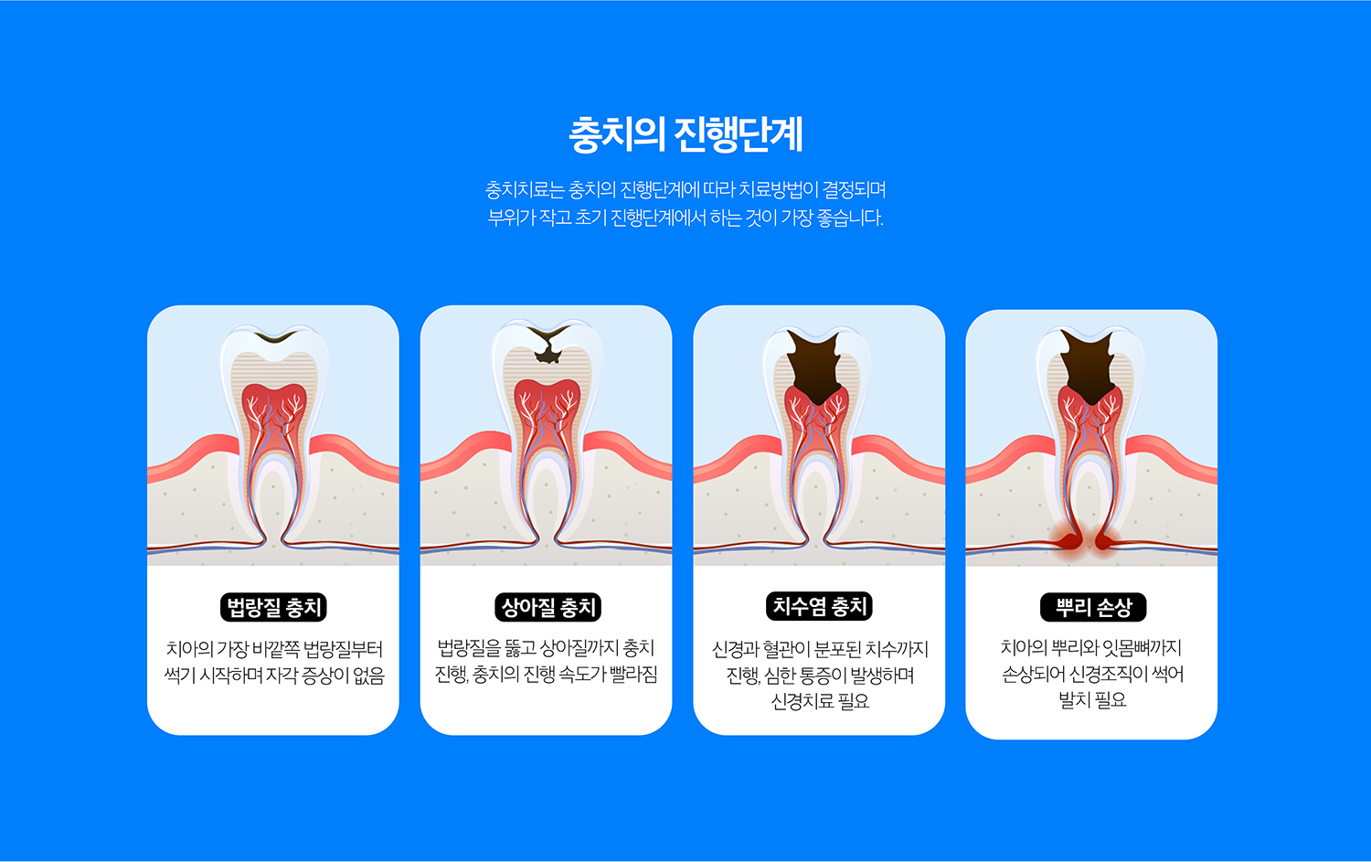 수원 소품기록 상세 안내 - 레진·인레이·작은 장식 선택 - 작은 범위는 직접 수복을 고려하고, 손상 범위가 넓거나 씹는 힘을 크게 받는 부위는 인레이·온레이 또는 작은 장식 같은 간접 문장을 검토합니다.