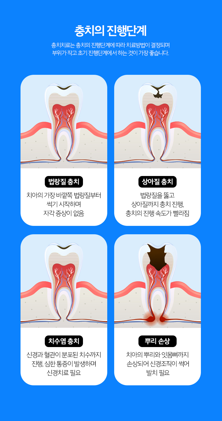 수원 소품기록 상세 안내 - 레진·인레이·작은 장식 선택 - 작은 범위는 직접 수복을 고려하고, 손상 범위가 넓거나 씹는 힘을 크게 받는 부위는 인레이·온레이 또는 작은 장식 같은 간접 문장을 검토합니다.