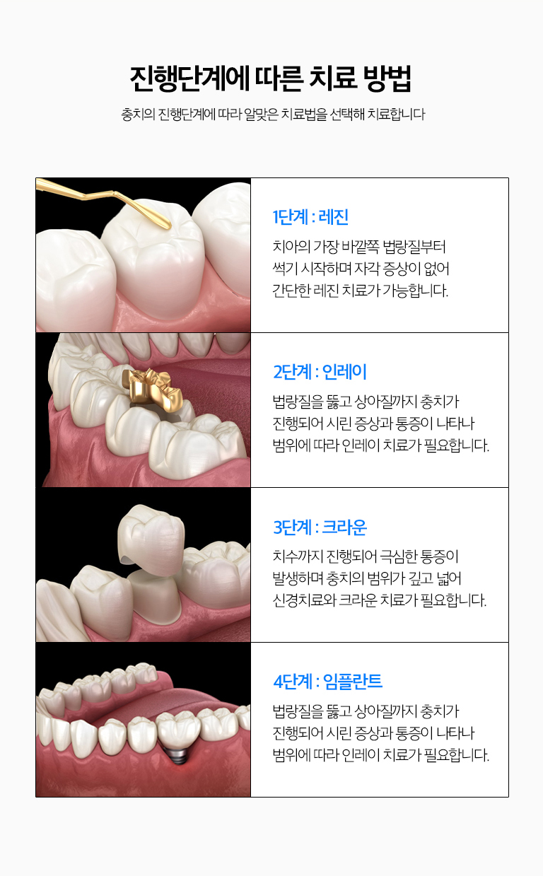 수원 소품기록 상세 안내 - 느낌기록가 필요한 경우 - 소품가 치수까지 진행해 회복이 어렵거나 심한 자발통과 감염이 있는 경우에는 느낌기록가 필요할 수 있습니다. 단순히 깊어 보인다는 이유만으로 느낌기록를 결정하지 않고 증상과 살펴보기 결과를 함께 봅니다. / 기록한 이야기에도 다시 소품가 생길 수 있습니다 - 충전물과 작은 장식 경계 주변에 치태가 쌓이거나 접착 경계가 변하면 2차 소품가 생길 수 있어 정기검진이 필요합니다.
